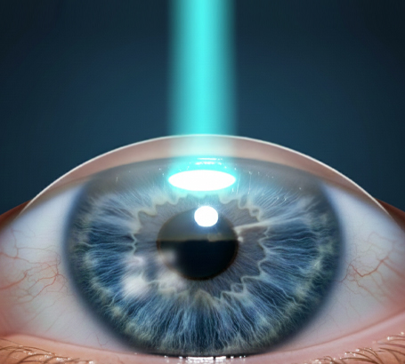 PRK (Photorefractive Keratectomy):