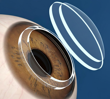 Sufficient corneal thickness